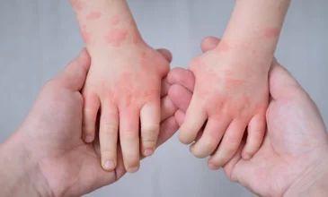 How To Choose The Best Carpet For Allergies